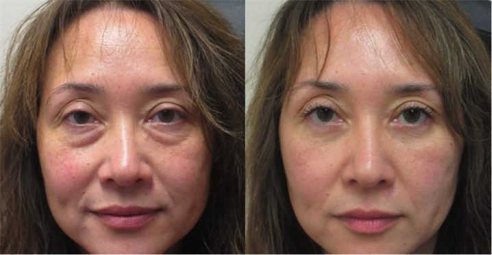 Linda M. — before and after